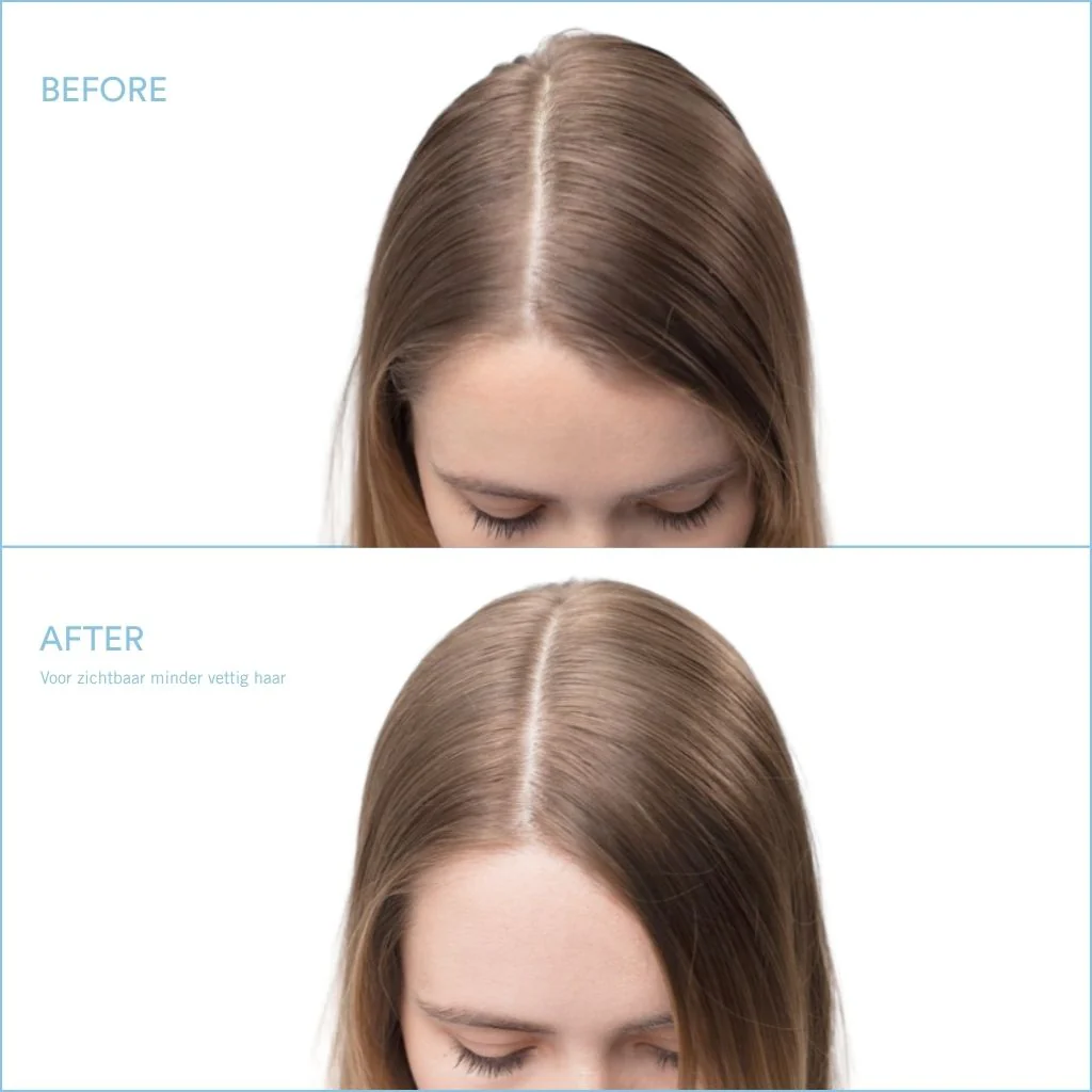 Scalp Clinix Oil Control Set - 300+200ml - Image 6